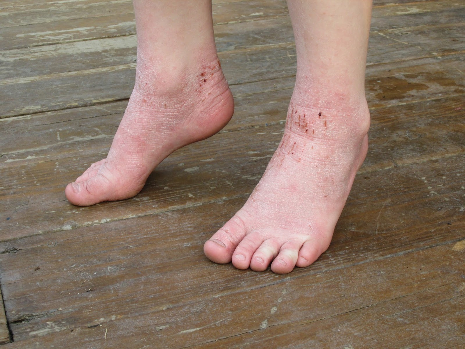 Itchy Rash On Top Of Foot Causes And Treatments New Health Advisor